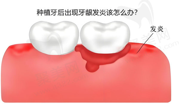 做完种植牙可能会感染