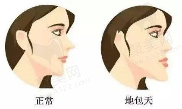 什么是地包天