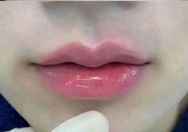 哈尔滨即美医疗美容厚唇变薄实例