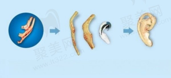 耳再造全包和直埋哪个好