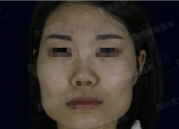 李继华做颧骨磨骨手术很不错