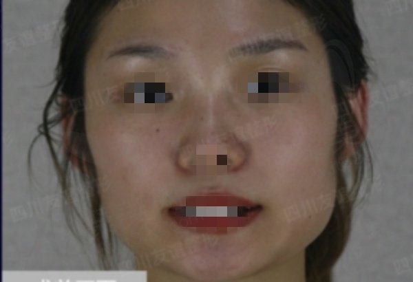 李继华做颧骨内推下颌角手术口碑好