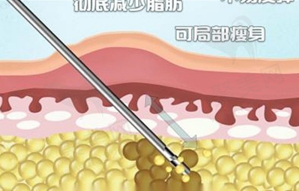 赵亚军吸脂出脂量大且平整