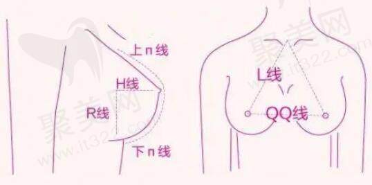 上海王志刚医生隆胸技术怎么样？