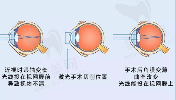 全光塑飞秒手术为啥如此受欢迎呢？