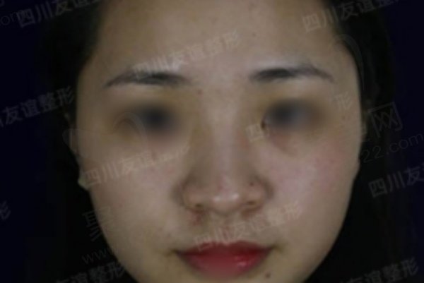 成都李萍做鼻子的真人实例