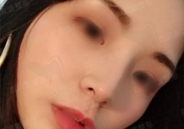 成都李萍做鼻子的真人实例