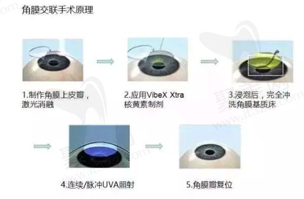 角膜交联手术<span style=