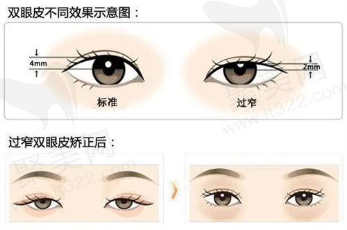 上海薇琳杨荣华医生RE-超IN妆感综合美眸优势