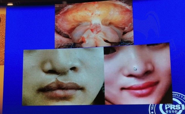 上海王健做唇裂图片