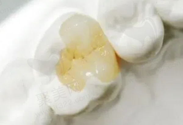 影响光固化补牙维持时间的因素