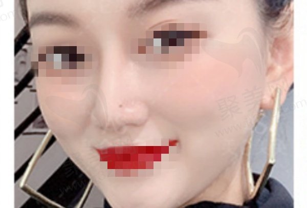 重庆杜亚旭做鼻子实例