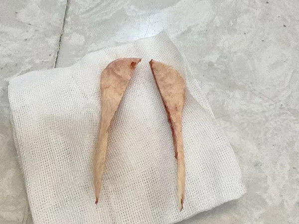 杭州连天美美容下颌骨整形
