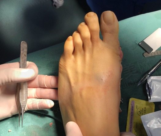 李昕宇医生拇外翻手术好吗？