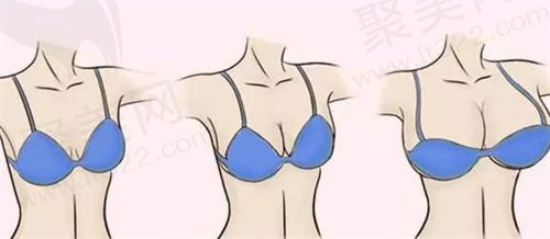 上海华美丰胸好不好? 上海华美丰胸好不好?