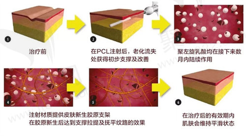 伊妍仕少女针的主要作用功效