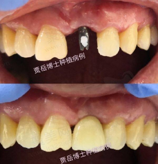 深圳卫康口腔医院贾岳医生种植实例