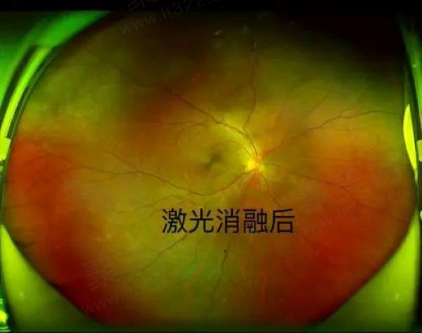 玻璃体混浊激光消融一次多少钱