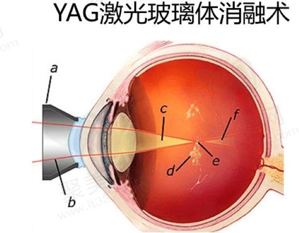 玻璃体激光消融术能完全去除混浊吗