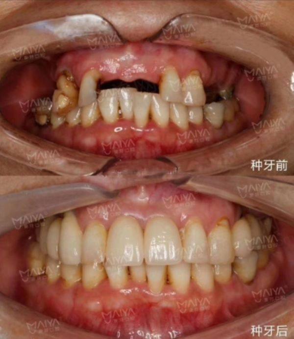 深圳麦芽口腔李泓甫医生种植牙怎么样