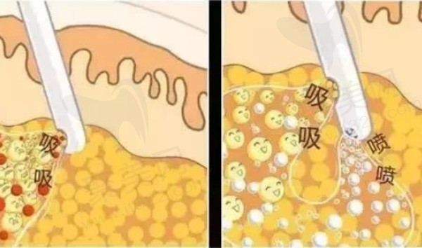成都新华朱慧东医生做吸脂技术优势