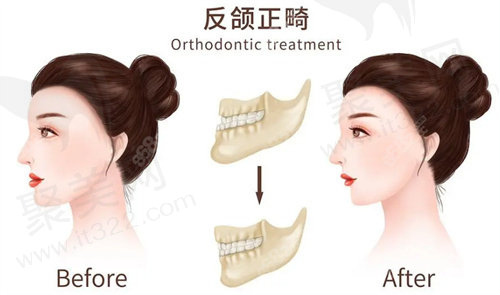 重庆松山医院正颌手术怎么样？