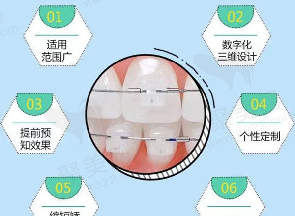 陶瓷自锁牙套和金属自锁牙套哪个好？