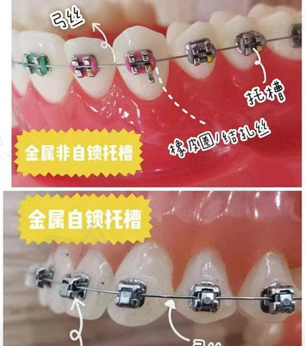 金属自锁牙套