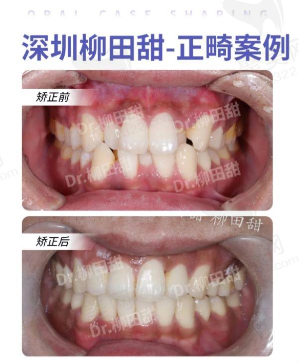 深圳佳美口腔柳田甜医生正畸实例