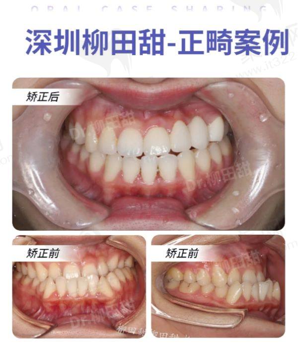 深圳佳美口腔柳田甜医生牙齿矫正实例