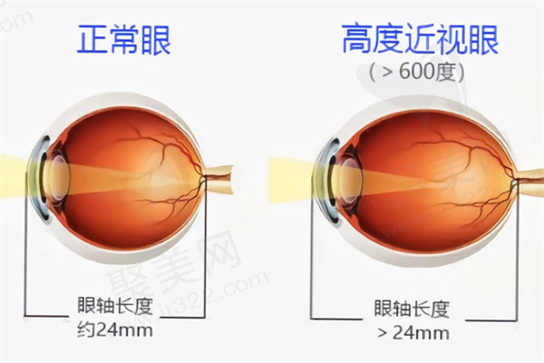 德爱尔眼科医院翁景宁晶体植入手术