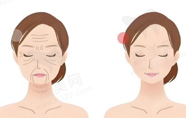 王志坚面部提升怎么样
