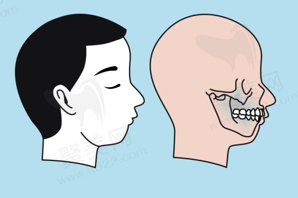 哪种凸嘴可以通过整牙来改善