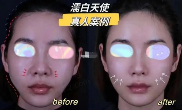 打濡白天使不会造成栓塞