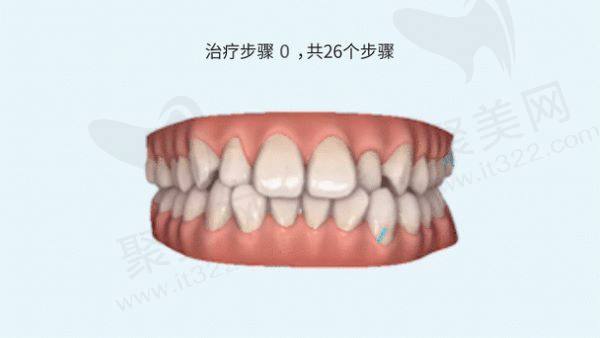 杭州美奥口腔牙齿矫正多少钱