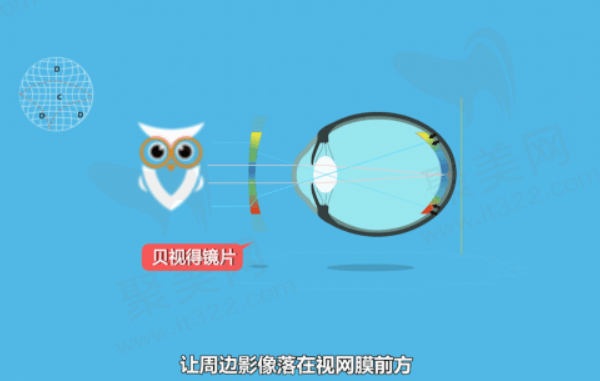 郑州尖峰眼科医院配星趣控近视防控离焦镜怎么样？