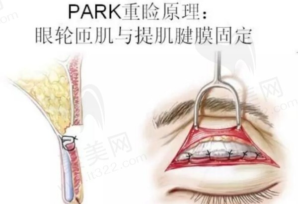 成都素美杨迪做双眼皮怎么样