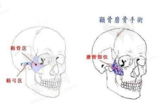 广州徐威强磨骨怎么样