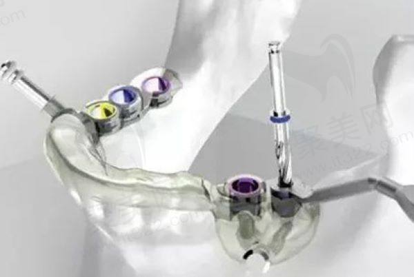 佛山登特口腔医院种牙价格表新