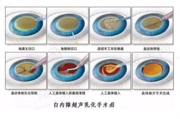 糖尿病做白内障手术示意图