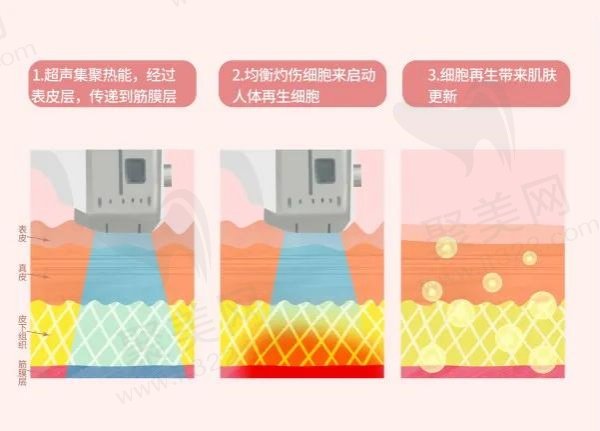 黄金超声炮有几个刀头几个炮头