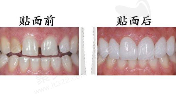杭州金铂利口腔牙齿美白多少钱