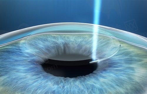 恩施慧宜眼科医院近视手术