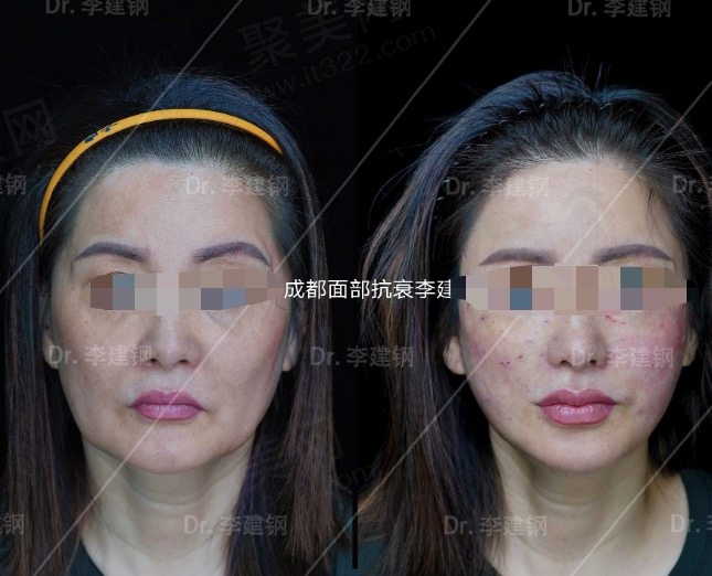 李建钢微创技术与术后：自然、持久、低风险