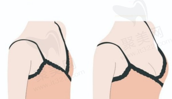 上海华美谢卫国隆胸实例 上海华美谢卫国隆胸实例