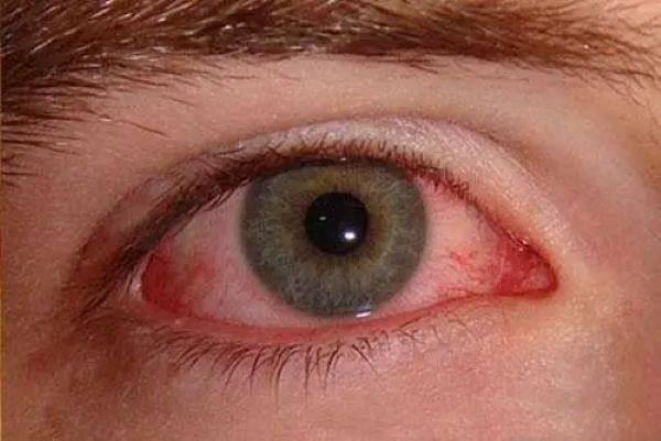 有结膜炎能做近视手术吗