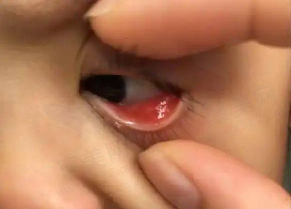 手术治疗霰粒肿的注意事项