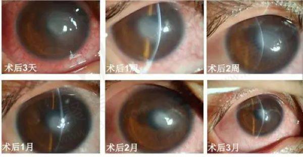 角膜交联手术多少钱