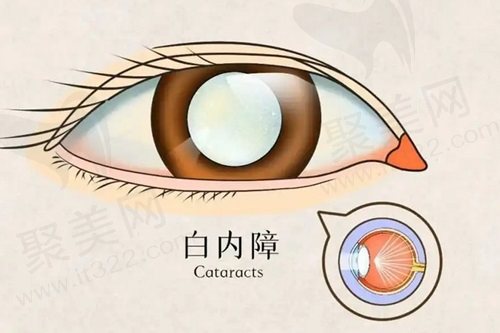 郑州尖峰眼科医院白内障价格表