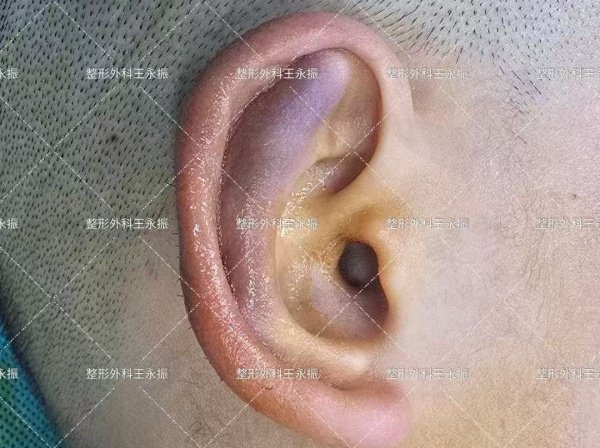 广州王永振医生耳再造真人实例